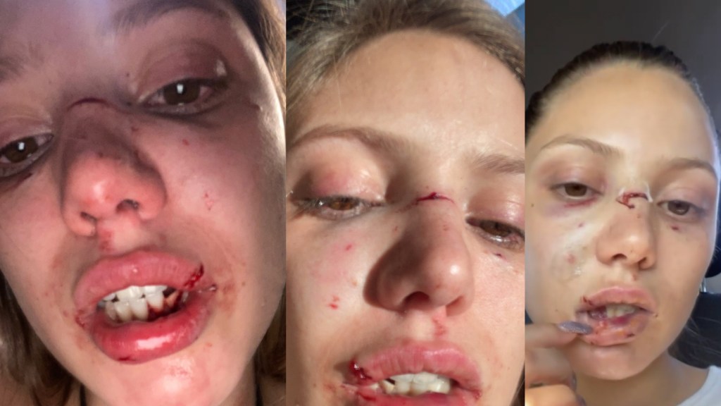 #POLICIALES | LA CONFUNDIERON CON OTRA MUJER Y LA DESFIGURARON A GOLPES CON UNA&nbsp;FRAPERA