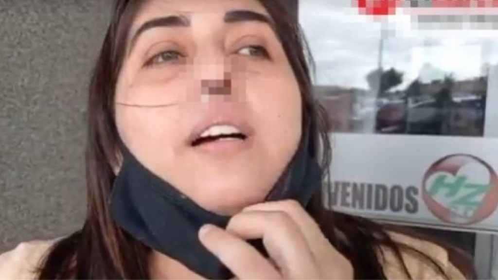 #COVID-19 | POR UN MAL HISOPADO UNA MUJER DE CALETA OLIVIA PERDIÓ EL CARTÍLAGO DE LA NARIZ 