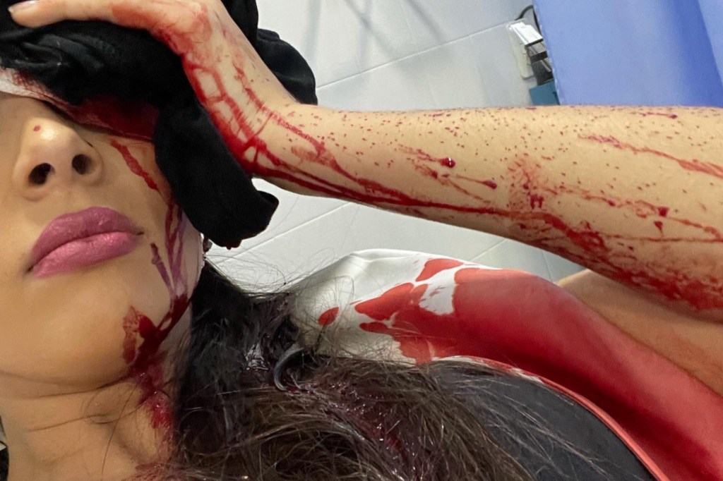 #POLICIALES | UNA CHICA FUE A BAILAR, LE ARROJARON UNA COPA DE VIDRIO A LA CARA Y CASI PIERDE UN&nbsp;OJO