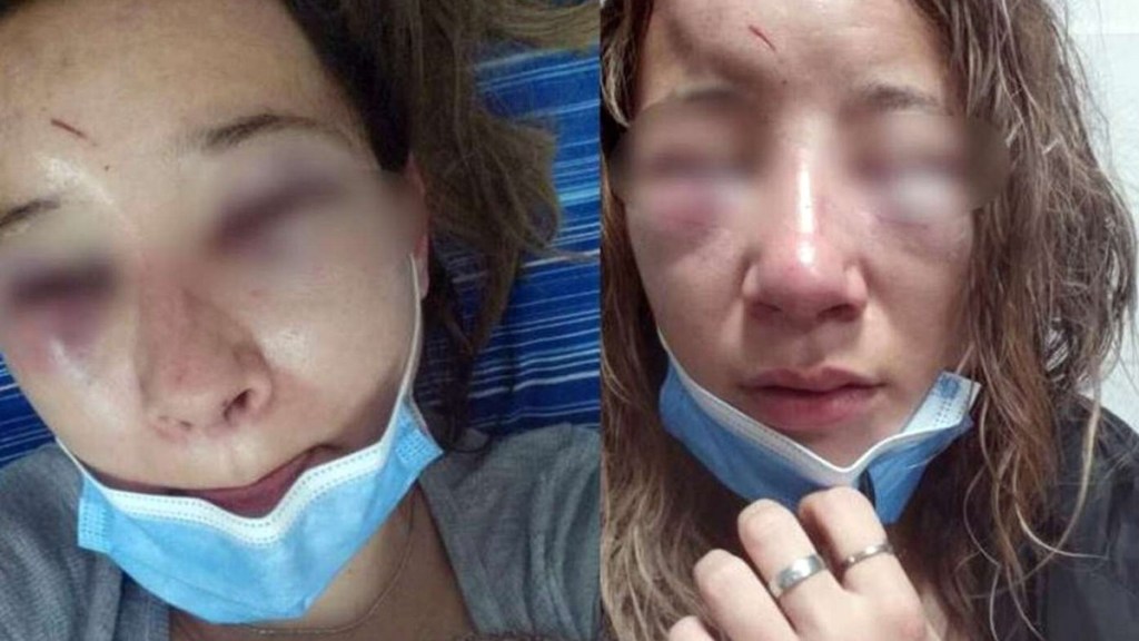 #HORROR | FUE A BAILAR Y DOS MUJERES TRANS LE DIERON UNA TERRIBLE GOLPIZA: LA DESFIGURARON Y LE ARRANCARON LAS&nbsp;UÑAS