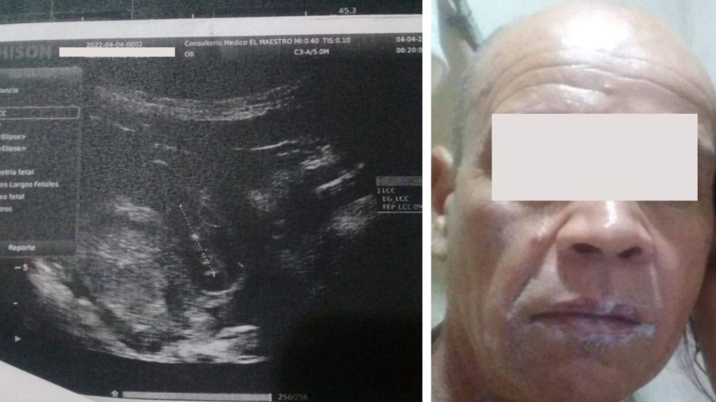 #HORROR | VIOLÓ A LA HIJA CON SÍNDROME DE DOWN DE SU PAREJA Y LA DEJÓ&nbsp;EMBARAZADA