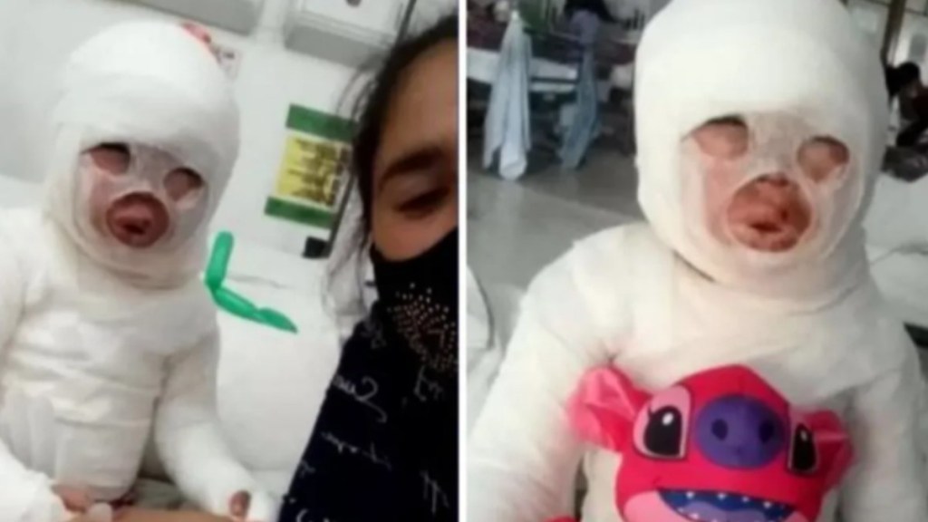 #HORROR | QUEMARON CON ACEITE HIRVIENDO A UNA NENA DE 3&nbsp;AÑOS