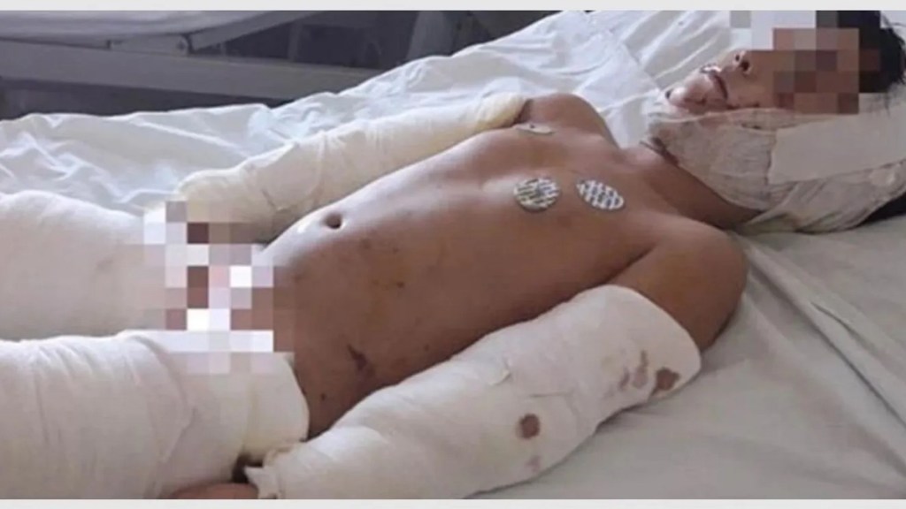 #HORROR | CUATRO PERROS ATACARON A UN NENE DE 8 AÑOS Y TUVIERON QUE HACERLE 110&nbsp;PUNTOS