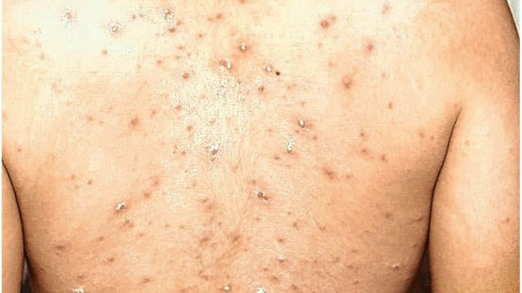 Viruela símica y herpes zóster: Entender las diferencias para evitar&nbsp;confusiones