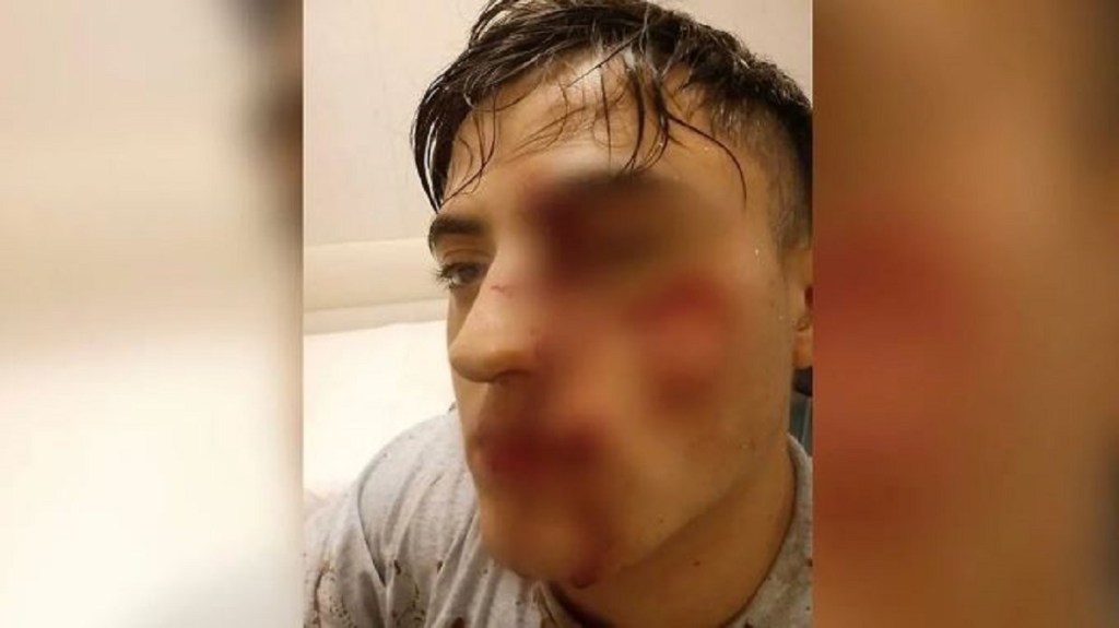 Atacó a un hombre que hablaba con su ex y lo dejó ciego de un&nbsp;ojo
