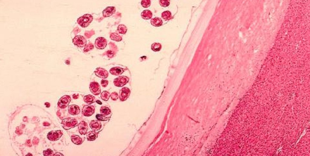 Hidatidosis, una enfermedad asintomática que daña la calidad de&nbsp;vida