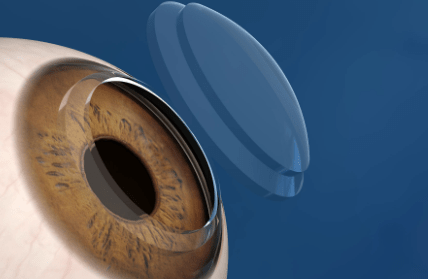 Trasplante de córnea: ¿qué pacientes lo necesitan y cómo es la&nbsp;recuperación?