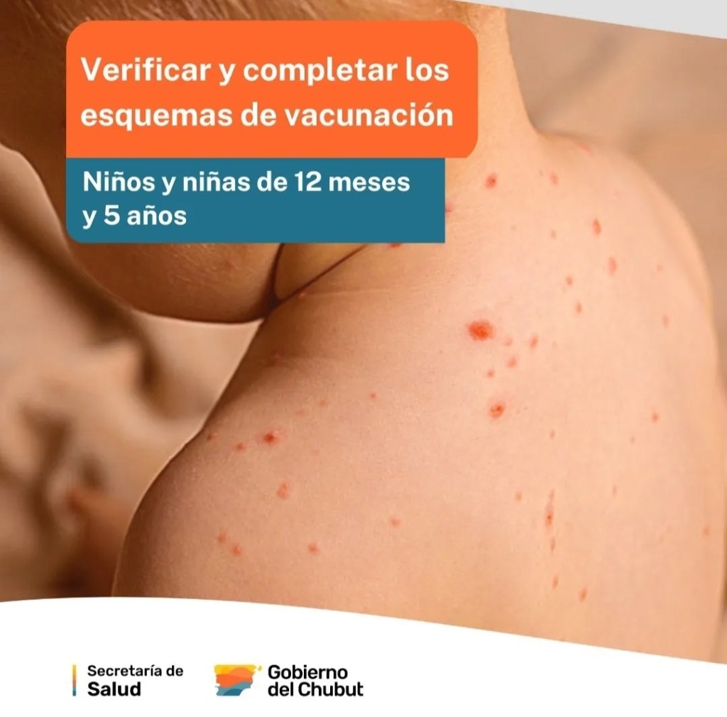 sarampión, vacuna triple viral, Chubut, Río Negro, Ministerio de Salud, Secretaría de Salud, Ignacio Torres, prevención de enfermedades, vacunación infantil, fiebre y exantema, brote de sarampión, Calendario Nacional de Vacunación, prevención del sarampión, salud pública
